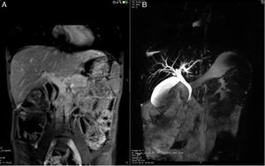 Case 2: cholangio MRI: (A) increased diameter of the common bile duct (12mm) and (B) irregular intrahepatic ducts with biliary ectasia and some segmental stenosis.