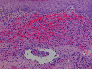 Hematoxylin and eosin stain of slit-like vascular spaces and red blood cell extravasation. In the center there is the Promontory Sign (arrow) (H&E ×200).