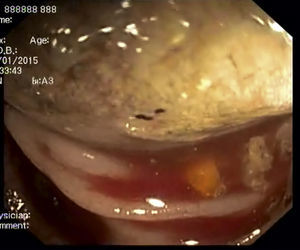 Endoscopic image of an extensive mass with a regular mucosal surface, occupied more than 2/3 of the circumference and conditioned lumen stenosis, in the descending colon.