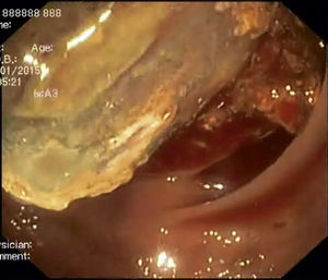 Endoscopic image of a mass with ischemia and ulceration at the distal top, in the descending colon.