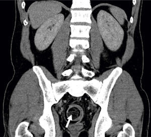 Abdominal CT (coronal view): colocolic intussusception in the terminal portion of the descending colon.