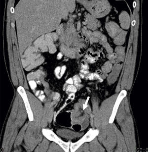 Abdominal CT (coronal view): lipomatosus mass with 7cm×4cm larger diameter in the.