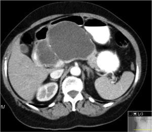 Computed tomography: giant well-defined multiloculated cystic mass in the body of the pancreas.