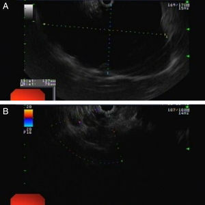 Endoscopic ultrasound: large multilocular cyst (A) with a microcystic pattern component (B).