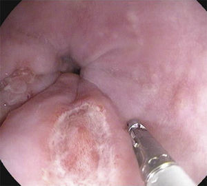 Esophagogastroduodenoscopy: lower third of the esophagus with a typical “punched-out” ulcer.