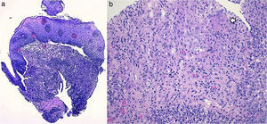 Esophageal biopsies histological examination: (a) hematoxilin & eosin 40× – intense inflammatory infiltrate permeating the mucosal, submucosal and muscle layers. (b) Hematoxilin & eosin 200× – non-caseous epithelioid granulomas with a giant cell (arrow).