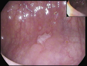 Ileocolonoscopy: active colitis with two superficial ulcers and a deep stellate ulcer in the left colon.