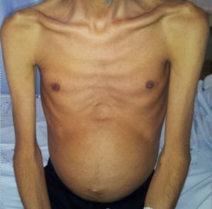 Severely emaciated patient with a distended abdomen.