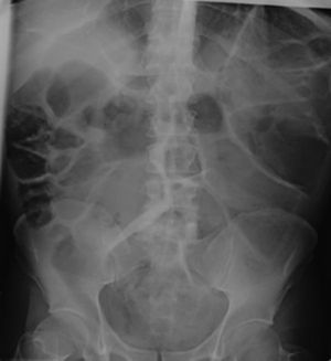 Standing abdominal X-ray showing severe dilatation of bowel loops.