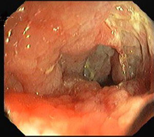Colonoscopy showing stenosis and ulceration of the small bowel.
