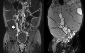 MRI-enterography showing contrast enhancement of the last ileal loop (left, arrow) and severe distention of a wide segment of the small bowel (right).