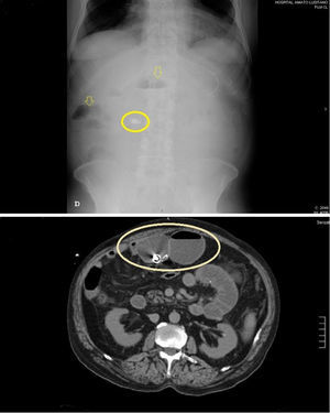 The abdominal X-ray and computed tomography showing air fluid levels, small bowel loops distention and a foreign body.
