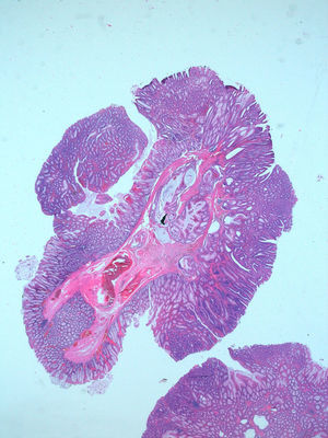 Aggregates of dilated and slightly irregular glands in the submucosa, in connection with the overlying mucosa (scanning microscopy).