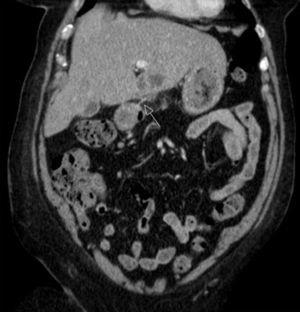 Foreign body (arrow) perforating the duodenum wall, contacting with the hepatic parenchyma.