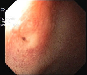 Fistulous opening in the antero-superior duodenal bulb wall.