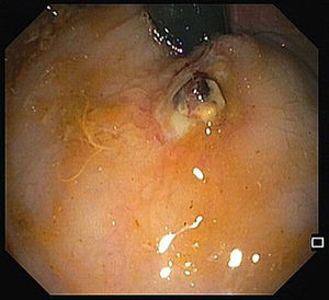 Ulcer with large vessel on the site of previous band ligation.