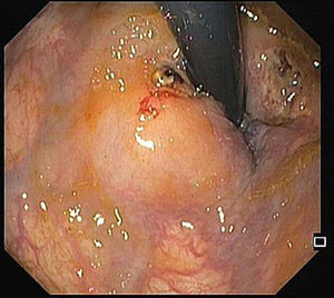 Ulcer with large vessel after submucosal injection of polidocanol. A second ulcer with some hematin, corresponding to the other ligation site, is also visible.