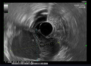 GIST-EUS shows a heterogeneous hypoechoic lesion of the forth gastric wall layer with lobulation measuring 10×6cm.
