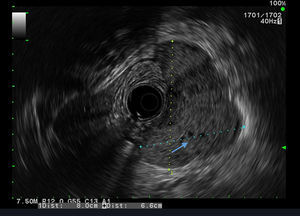GIST-EUS shows a heterogeneous hypoechoic lesion of the forth gastric wall layer with lobulation measuring 8.0×6.6cm.