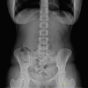 Plain abdominal radiograph showing an open safety pin.