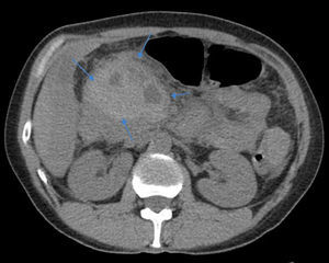 Peripancreatic collection with spontaneously hyperdense content suggestive of hematoma (arrows) (abdominal CT, before contrast administration).