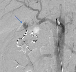 Recurrence of bleeding from the gastroduodenal artery (arrow) (second angiography).