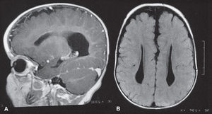 TSkull computed tomography. (A) Sagittal view showing the corpus callosum agenesis and hypoplasia of the cerebellar vermis; (B) Cross-sectional view showing hypoplasia of the vermis and lateral ventricles