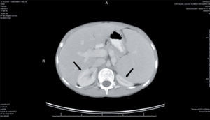 Abdominal computed tomography, showing homogeneous hepatosplenomegaly, exerting posterior compression on the kidneys. São Paulo, SP, Brazil, 2014. The arrows indicate the compression of the kidneys bilaterally by hepatomegaly (R) and splenomegaly (L).