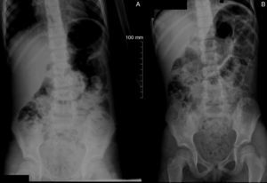 Abdominal X-rays in the standing (A) and supine (B) position, disclosing large amount of stool in the ascending and descending colon, sigmoid and rectum. Dilation in the rectosigmoid segment, secondary to the presence of stool, can also be observed.