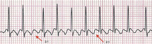 Electrocardiogram showing the “sawtooth” or “picket fence” pattern of atrial flutter, with 3:1 and 2:1 atrioventricular conduction in the D2 lead.