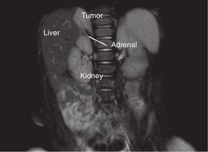 Close association between intra-abdominal extralobar pulmonary sequestration and right adrenal gland in magnetic resonance imaging (T2 images).