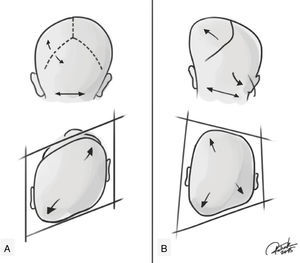 Representation of positional plagiocephaly and true (synostotic) posterior plagiocephaly. (A) Positional plagiocephaly showing: absence of lambdoid suture stenosis, format of a parallelogram skull, ipsilateral compensatory frontal bossing, ipsilateral ear in an anterior position, as if it had been pushed. (B) True posterior plagiocephaly showing: presence of lambdoid suture stenosis, shape of a trapezoid, ipsilateral bulging in the mastoid region, contralateral compensatory frontal bossing, ipsilateral ear stenosis tends to be in a posterior position and downwards, as if the suture pulled it. Credits: Patrick Braga.
