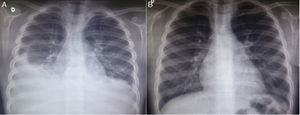 Chest radiography images of the patient in the posteroanterior view; A–at patient admission, costophrenic sinus obliteration is observed bilaterally, with pleuropulmonary opacity to the right; B–six months after discharge, during an outpatient consultation, the radiography shows no alterations.