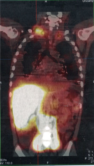 SPECT/CT image of the cervicothoracic and abdominal regions obtained from the lymphoscintigraphy assessment with intradermal administration of dextran-99mTc on the dorsum of the feet; the images obtained 18hours after start of the examination show focal area of radiotracer retention/leakage in the lymph ducts located in the topography of the thoracic introit, bilaterally, more accentuated to the right.