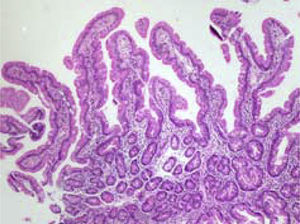 Duodenal biopsy specimens (case 1): mean increase (10×) showing fingerlike villi, preserved crypts, villus:crypt ratio 4:1.