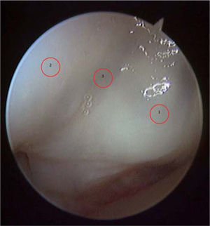 – Visión artroscópica distal desde el portal 3-4. 1: escafoides proximal; 2: semilunar proximal; 3: ligamento escafolunar.