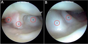 – A y B) Visión artroscópica de los ligamentos volares desde el portal 3-4. 1: ligamento radioescafolunar (Testut-Kuentz); 2: ligamento radiolunar largo; 3: ligamento radiolunar corto; 4: ligamento radioescafocapitate.
