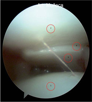 – Visión artroscópica de la articulación escafotrapeciotrapezoide desde el portal MC-R. 1: escafoides distal; 2: trapezoide proximal; 3: trapecio proximal; 4: articulación trapeciotrapezoidea.