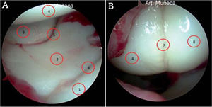 – A) Visión artroscópica proximal de la articulación mediocarpiana desde el portal MC-U. 1: piramidal distal; 2: semilunar distal; 3: escafoides distal; 4: hueso grande proximal; 5: articulación escafolunar distal; 6: articulación lunotriquetal distal. B) Visión artroscópica distal de la articulación mediocarpiana desde el portal MC-U. 7: ligamento capitohamate; 8: ganchoso proximal.
