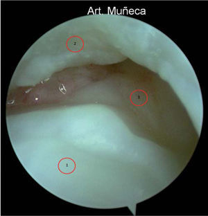 – Visión artroscópica desde el portal radioulnar dorsal distal. 1: cabeza distal del cúbito; 2: cara proximal del disco del CFCT; 3: inserción foveal del CFCT.