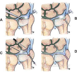 – Técnica de reinserción a la fóvea mediante túneles transóseos: el legrado de la fóvea se lleva a cabo desde el portal radiocubital distal dorsal, mientras el artroscopio se mantiene en el portal radiocubital distal volar (A). Se realizan dos túneles óseos de 2mm de diámetro desde 15mm proximales a la punta de la estiloides, convergiendo hacia la zona de la fóvea (B). Procederemos entonces a introducir una hebra de PDS 3/0 a través de unos de los túneles que perforará el ligamento radiocubital distal dorsal y se recuperará a través del ligamento radiocubital distal volar hacia el exterior (C). Ambos hilos se anudarán sobre el periostio, prestando especial atención a no dañar o estrangular las ramas terminales de la rama sensitiva dorsal del nervio cubital (D). Es recomendable estabilizar la articulación radiocubital distal con dos agujas de Kirschner en posición de reducción articular durante 5 semanas.