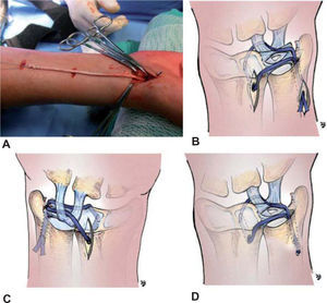 – La plastia de los ligamentos radiocubitales distales con injertos tendinosos libres con hemitendón radial del FCR puede ser realizada con o sin control artroscópico. Es una técnica compleja que requiere una curva de aprendizaje. Su control artroscópico permite la correcta localización de la fóvea del cúbito, punto isométrico de los ligamentos reconstruidos. A) Manera de obtener el injerto del FCR mediante incisiones discontinuas muy estéticas en una muñeca derecha. B) Orientación de la plastia en una visión dorsal. C) Visión volar de la ligamentoplastia, donde destaca el pasaje del injerto entre los ligamentos ulnocarpales. D) La plastia se estabiliza al cúbito mediante un tornillo de tenodesis.
