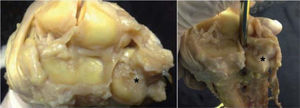– Preparaciones anatómicas de la articulación radiocarpiana de una muñeca derecha. Se ha desinsertado el disco del FCT y ambos ligamentos radiocubitales distales de su inserción en el radio y se ha revertido el CFCT a cubital. Los asteriscos marcan la localización de la fóvea, donde se insertan los ligamentos radiocubitales distales. La fóvea se halla en el cuadrante dorsoulnar de la superficie de la extremidad distal del cúbito.