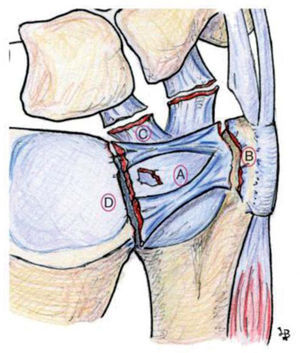 – Representación esquemática de los diferentes tipos de lesión clase I de Palmer. IA: perforación central; IB: desinserción periférica; IC: desinserción distal de los ligamentos ulnocarpales; ID: desinserción radial.