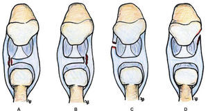 – Imagen que esquematiza que tanto las desinserciones periféricas tipo IB de Palmer (A y B) como las IC (C y D) pueden afectar tanto a la zona dorsal como a la zona volar de la articulación.