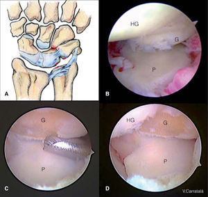 – A) Dibujo de las lesiones encontradas en el síndrome HALT (Hamate Arthrosis Lunotriquetral Instability). B) Visión desde el portal mediocarpiano radial; observamos la lesión condral en el polo proximal del ganchoso (G) y abundante sinovitis en el contexto de un síndrome HALT con pinzamiento ulnocarpiano. C) Visión desde el portal mediocarpiano radial. Resección del polo proximal del ganchoso con la fresa desde el portal mediocarpiano ulnar. D) Visión desde el portal mediocarpiano radial. Resultado final tras la resección de 2mm del polo proximal del ganchoso. HG: hueso grande; P: piramidal.