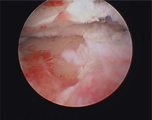 – Lesión condral radiocarpiana asociada a una fractura de extremidad de radio compleja.