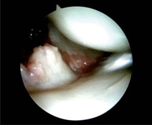 – Rotura parcial del ligamento radioescafocapitate en un caso de fractura extraarticular del radio distal.