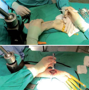 – Una vez completada la artroscopia diagnóstica se libera la tracción y se coloca la mano en supinación sobre la mesa para realizar la fijación por vía volar.