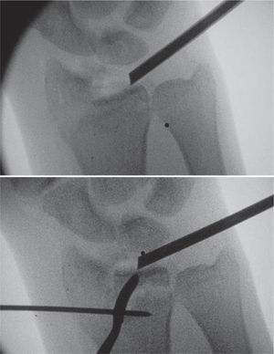 – Imagen de fluoroscopia donde se observa cómo se levanta el fragmento hundido del die-punch con ayuda de un periostótomo de pequeños fragmentos a través del portal 3-4.